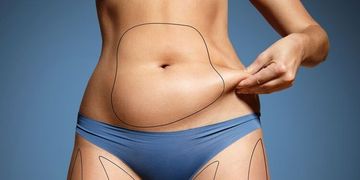 Liposukce, abdominoplastika nebo obojí?
