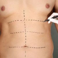 Liposukce může zkrášlit i muže