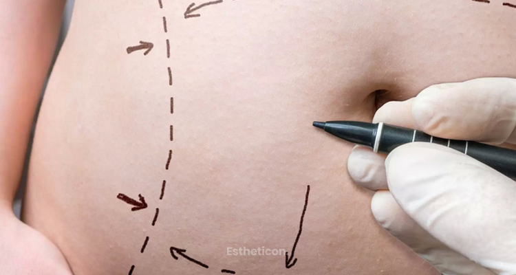 Liposukce přístrojem body-jet patří mezi nejšetrnější