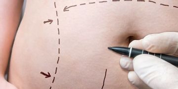 Liposukce přístrojem body-jet patří mezi nejšetrnější Liposukce přístrojem body-jet patří mezi nejšetrnější