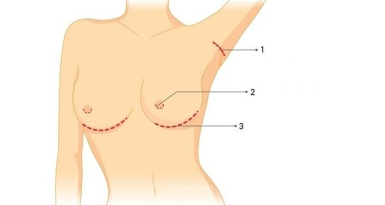 Metody vložení prsních implantátů při zvětšení prsou
