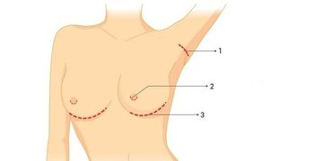 Metody vložení prsních implantátů při zvětšení prsou