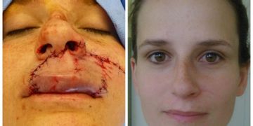 Potrhaný obličej po incidentu se psem a stačila jen jedna operace