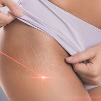 Využití laserů v dermatologii