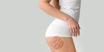 Zeštíhlení bez skalpelu? Neinvazivní metoda liposukce, která funguje