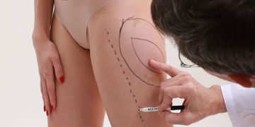 Jaký je rozdíl mezi laserovou liposukcí a klasickou liposukcí Jaký je rozdíl mezi laserovou liposukcí a klasickou liposukcí