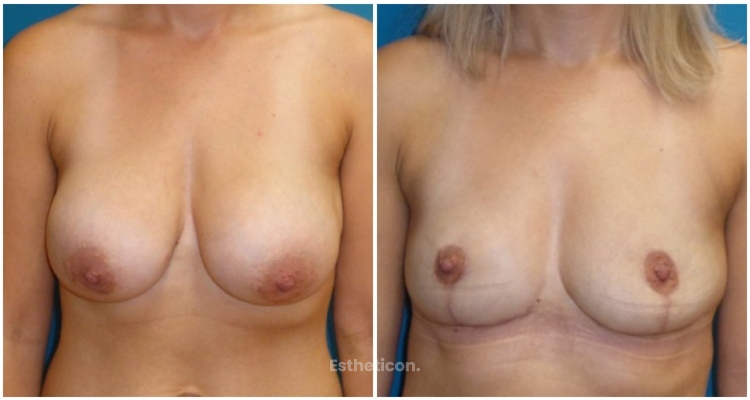 Explantace z důvodu Breast Implant Illness (BII) - nemoci prsních implantátů