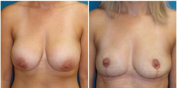 Explantace z důvodu Breast Implant Illness (BII) - nemoci prsních implantátů