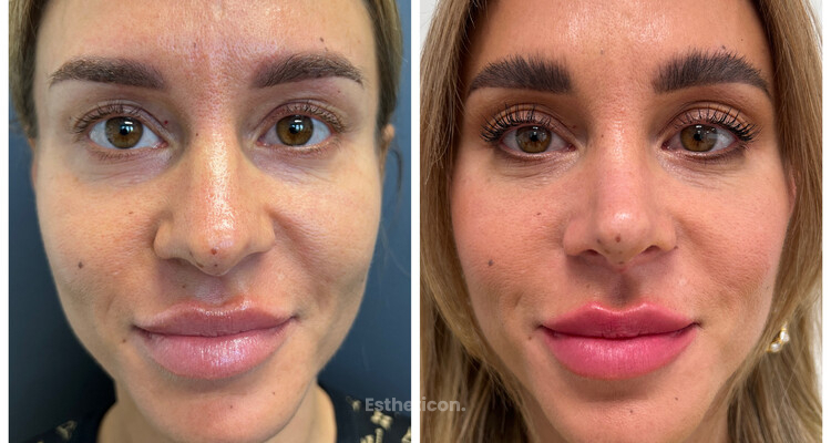 Lepší výsledky, rychlejší hojení. To je ultrazvukem asistovaná rhinoplastika