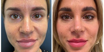 Lepší výsledky, rychlejší hojení. To je ultrazvukem asistovaná rhinoplastika