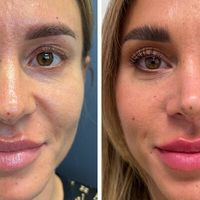 Lepší výsledky, rychlejší hojení. To je ultrazvukem asistovaná rhinoplastika