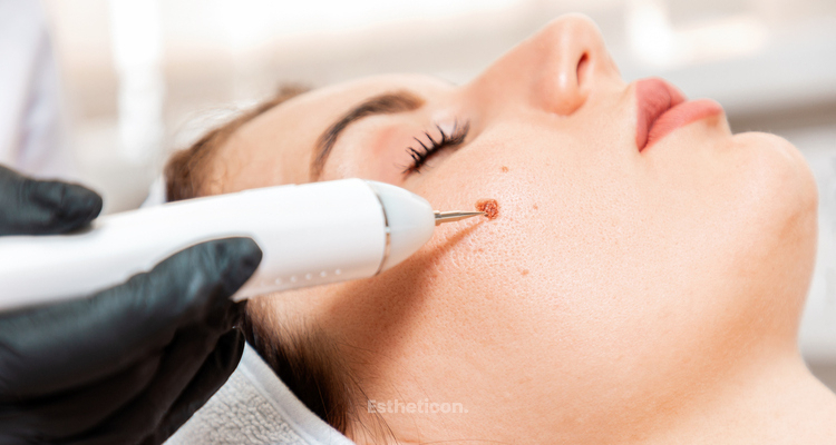 Laser, kryoterapie nebo kyselina salicylová: co funguje nejlépe na bradavice?