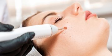 Laser, kryoterapie nebo kyselina salicylová: co funguje nejlépe na bradavice?