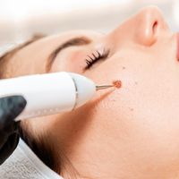 Laser, kryoterapie nebo kyselina salicylová: co funguje nejlépe na bradavice?