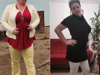 Gastrický bypass před a po - 878927