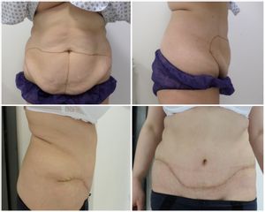 Abdominoplastika - MUDr. Issam Al Awa MD