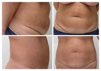 Laserová Liposukce - MUDr. Issam Al Awa MD