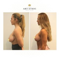 Modelace prsou - MUDr. Issam Al Awa | Art Ethic Beauty Clinic