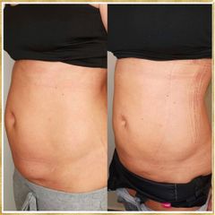 Laserová Liposukce - MUDr. Issam Al Awa | Art Ethic Beauty Clinic
