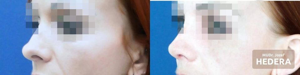 Rhinoplastika