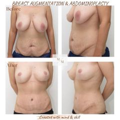 Modelace prsou s augmentací a abdominoplastika -  MUDr. Martin Molitor, Ph.D., MBA