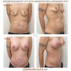 Modelace prsou s augmentací a abdominoplastika -  MUDr. Martin Molitor, Ph.D., MBA