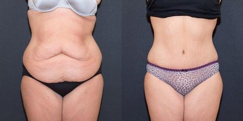 phoca thumb l tummy tuck before after 1