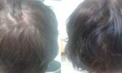 Vlasová mezoterapie