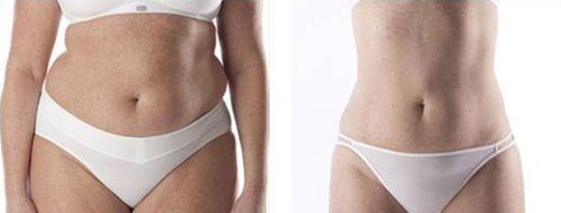 slimlipo4