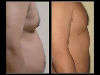LaserLipo8