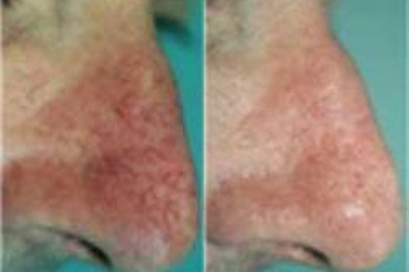 Laserové odstranění rozšířených žilek před a po - 729861