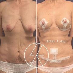 ref contures miniabdomin 1