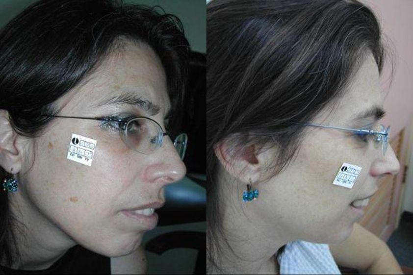 Fotorejuvenace IPL před a po - 718630