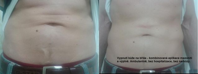 povisla kuze na brise   pred