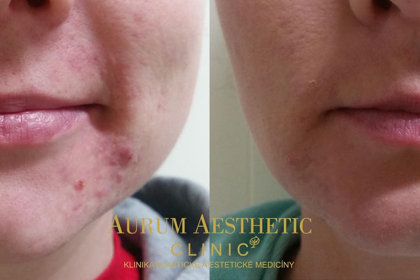 Microneedling před a po - 800246