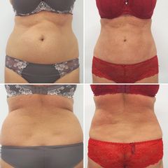Laserová Liposukce - MUDr. Petr Šuk - MEDICOM Clinic