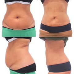 Laserová Liposukce - MUDr. Petr Šuk - MEDICOM Clinic