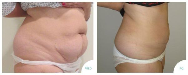 Abdominoplastika