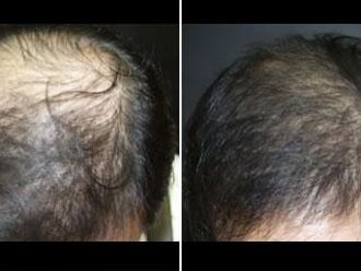 Vlasová mezoterapie - 732786