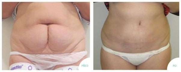 Abdominoplastika s liposukci bricha