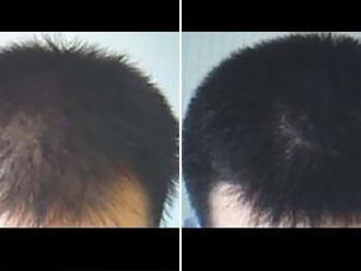 Vlasová mezoterapie - 732807