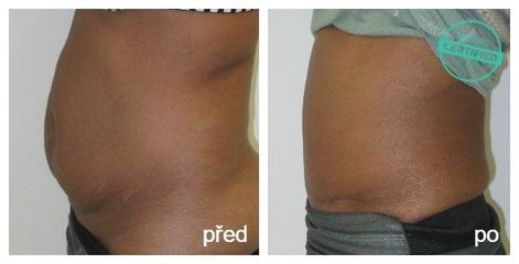 Abdominoplastika s liposukci