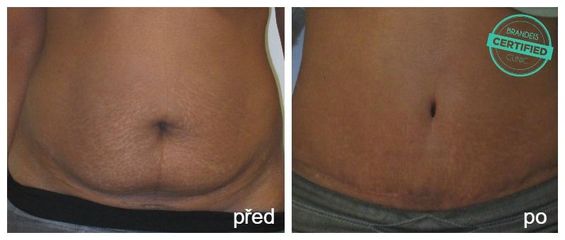 Abdominoplastika s liposukci