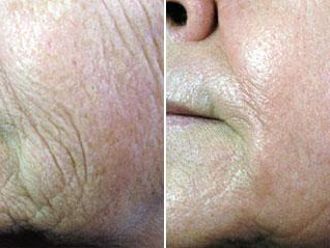 Fotorejuvenace IPL - 732896