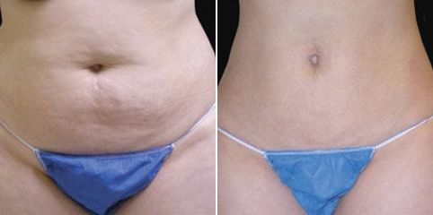 liposukce laser 1