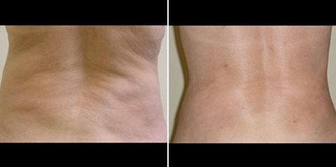 liposukce laser 3