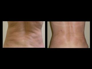 liposukce 2