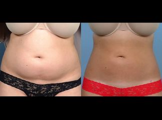 liposukce 3