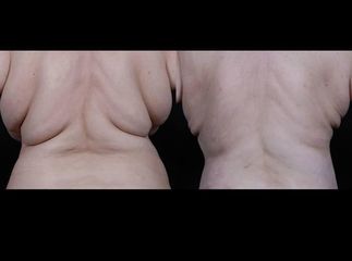 liposukce 4