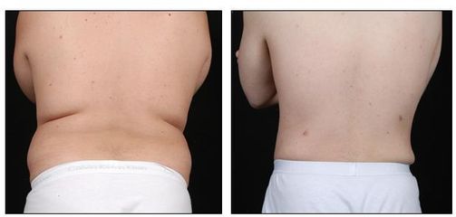 liposukce 6